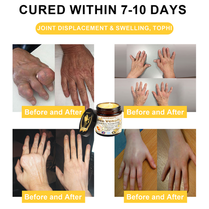 ArthroEase Bee Venom Arthritis Therapy Cream(Specially for older adults & AAOS recommends)